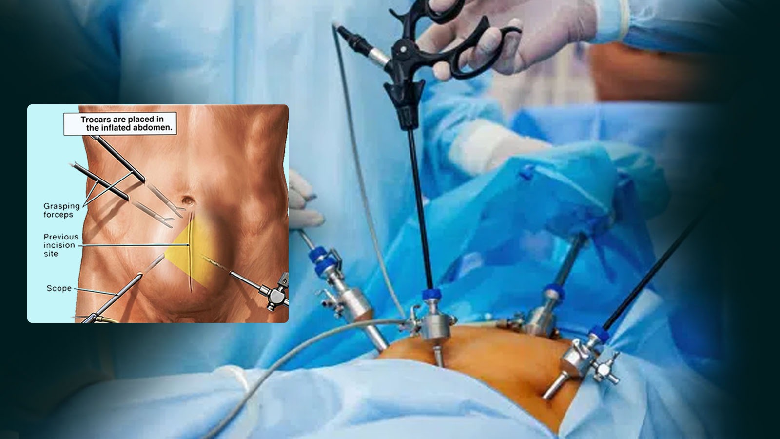 Read more about the article Best Laparoscopic Hernia Surgery Surgeon Kolkata