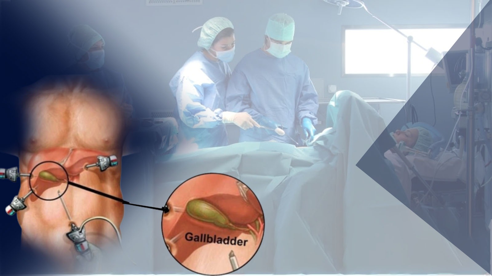 Read more about the article Best Laparoscopic Cholecystectomy Surgeon Kolkata