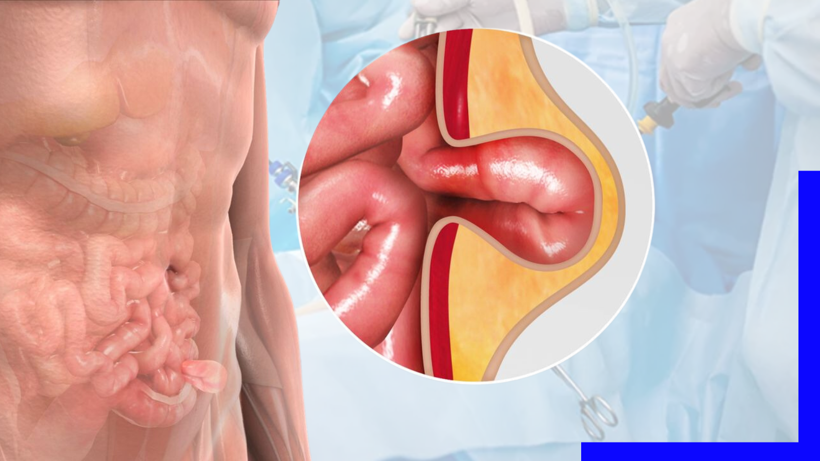 Read more about the article Best Laparoscopic Hernia Surgeon in Kolkata