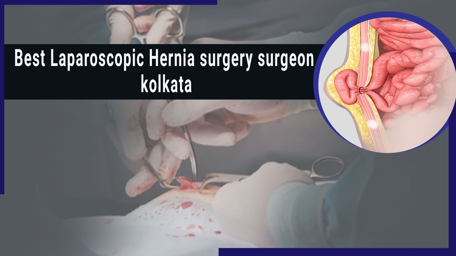 Read more about the article Best Laparoscopic Hernia Surgery Surgeon Kolkata