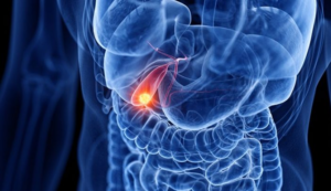 Read more about the article How Gall Stone is Related to Gall Bladder Cancer?