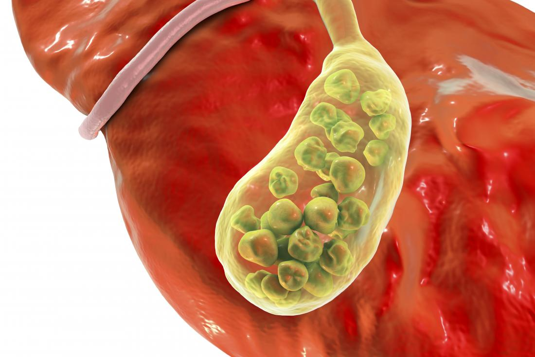 You are currently viewing Gallbladder Stones and Inflammation: The Role of Chronic Inflammation in Stone Formation