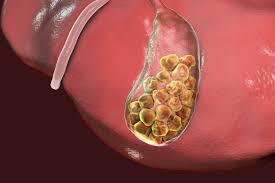 When Gallstones Get Complicated: What Every Patient Should Understand