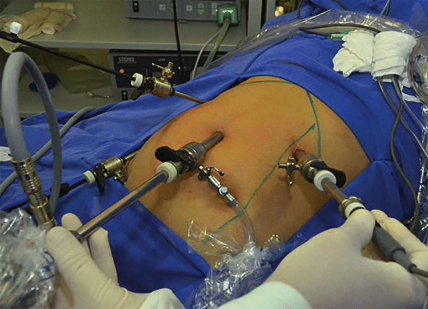 You are currently viewing Laparoscopic Cholecystectomy: A Modern Solution for Gallbladder Issues