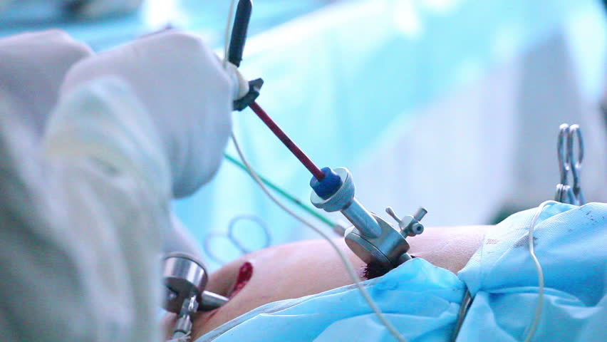 You are currently viewing Common Myths About Laparoscopic Surgery Debunked