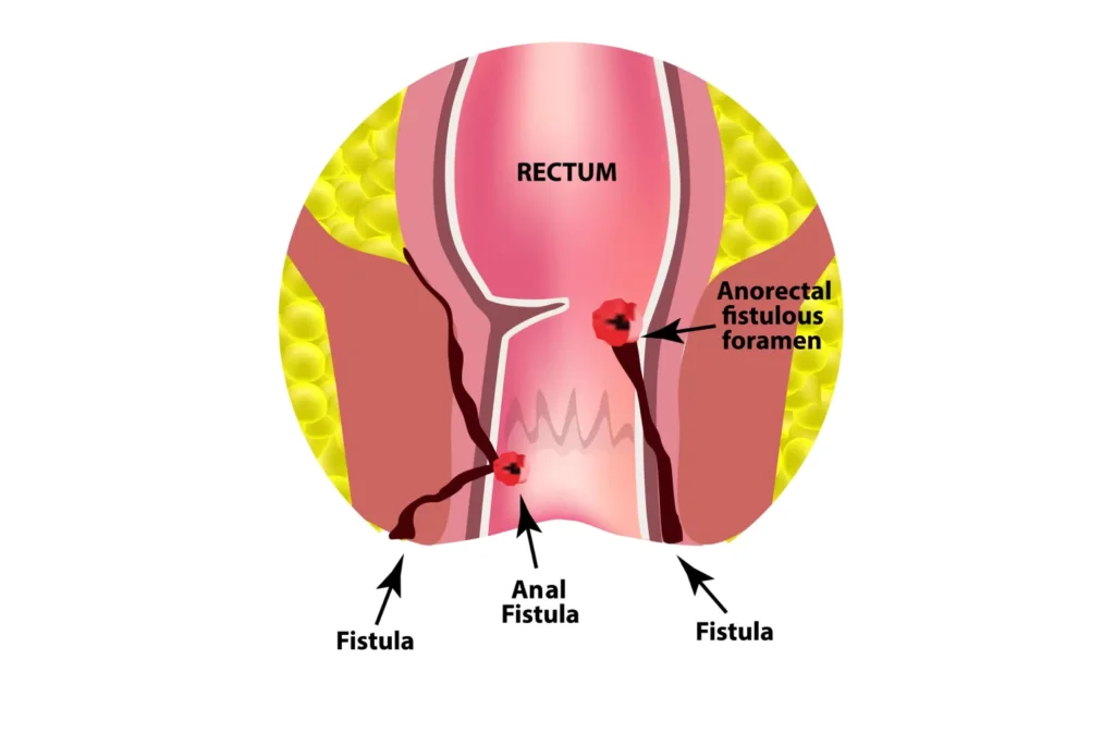 Anal Fistulas: Symptoms, Diagnosis & Surgery