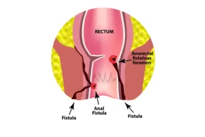 Read more about the article Anal Fistulas: Symptoms, Diagnosis & Surgery