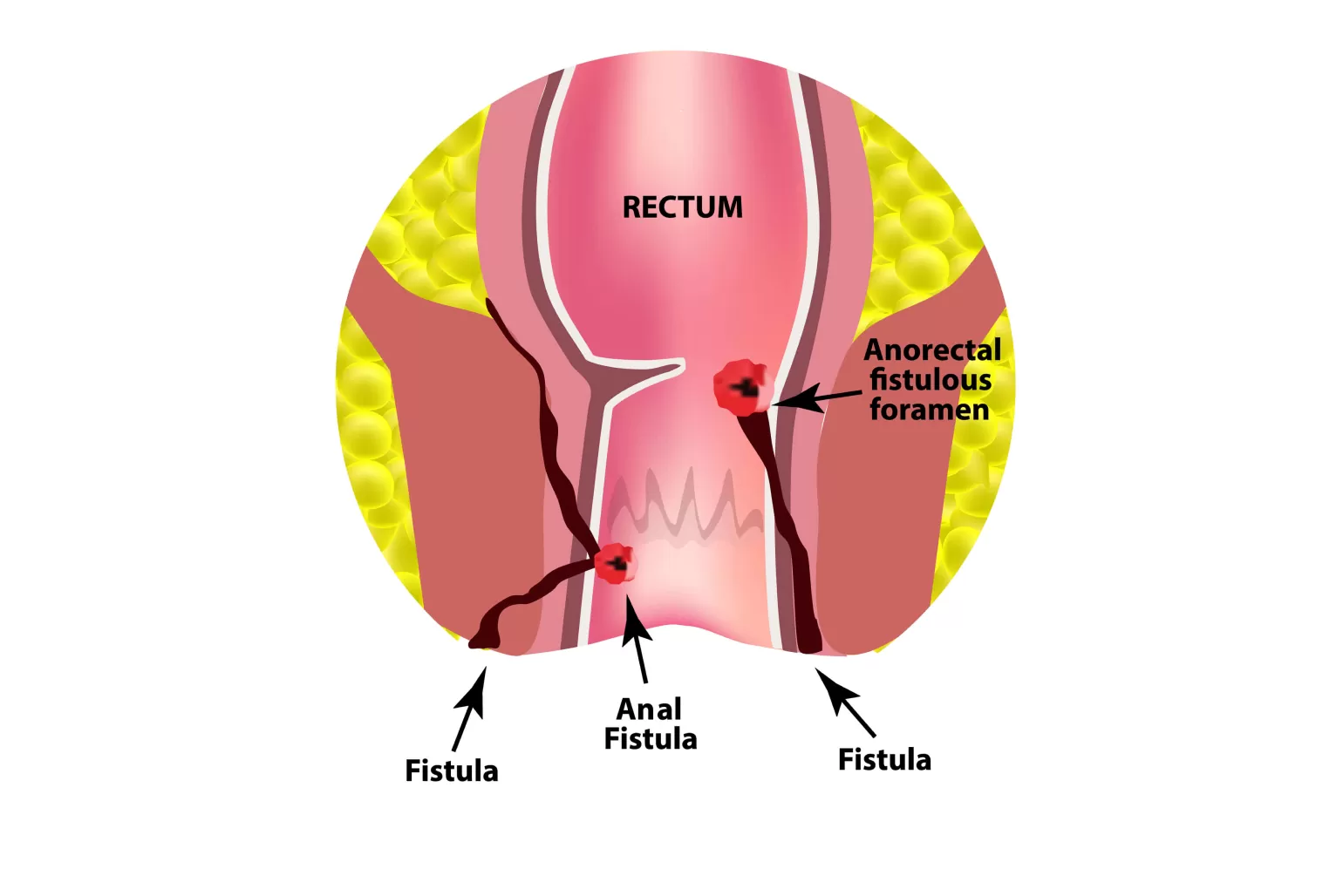 You are currently viewing Anal Fistulas: Symptoms, Diagnosis & Surgery