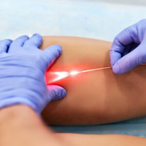 Read more about the article Benefits of Laser Ablation Over Traditional Surgical Methods