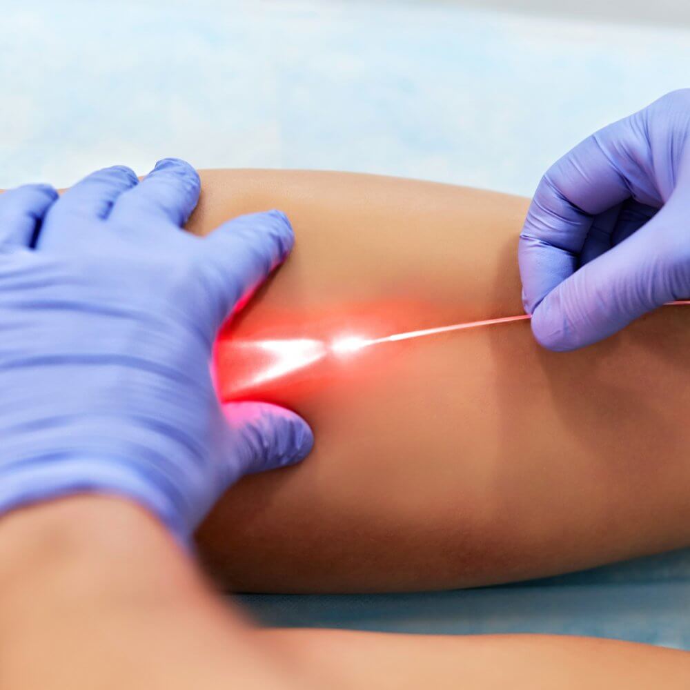 Benefits of Laser Ablation Over Traditional Surgical Methods