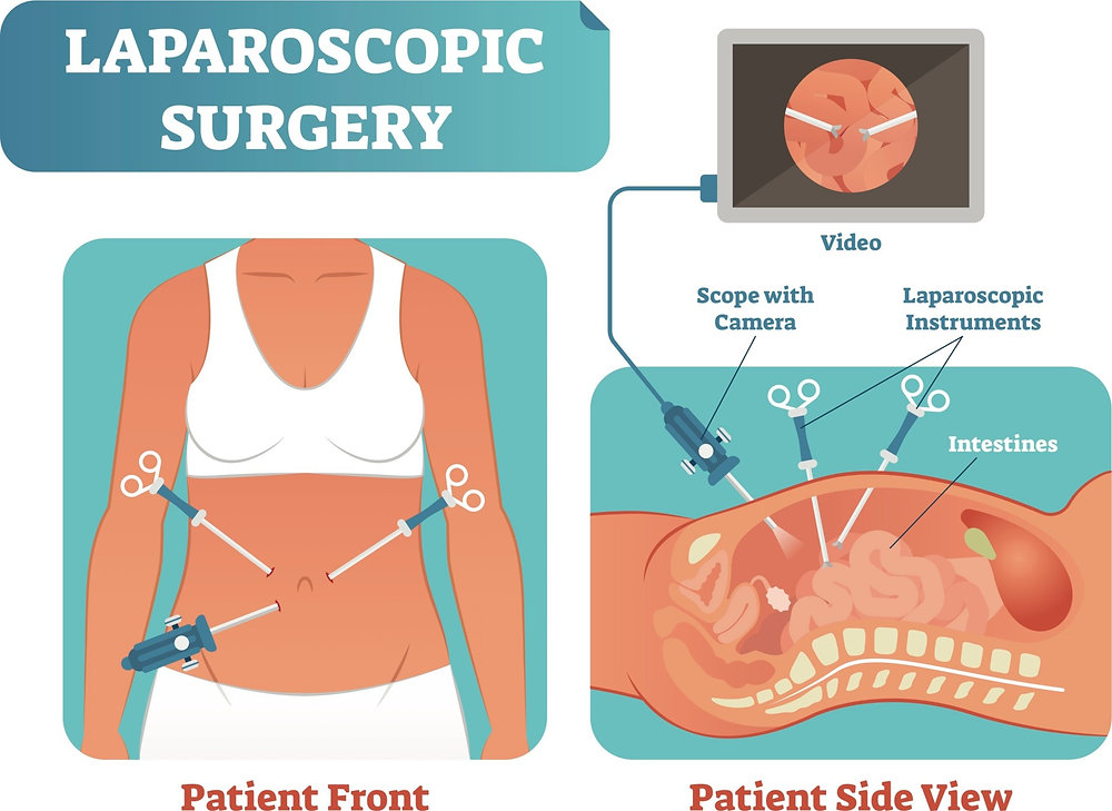 The Role of Laparoscopic Surgery For Abdominal Metastases