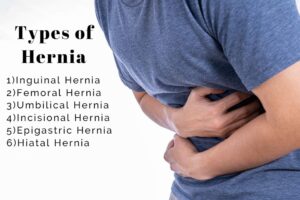 Read more about the article What Types of Hernias Are Best Treated with Laparoscopic Hernia Repair?