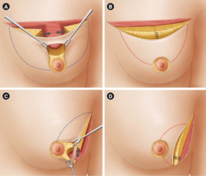 Read more about the article What Is Oncoplastic Breast Surgery?