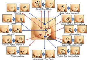 Read more about the article Breast Reconstruction After Cancer: What You Should Know