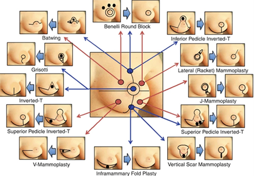 Read more about the article Breast Reconstruction After Cancer: What You Should Know